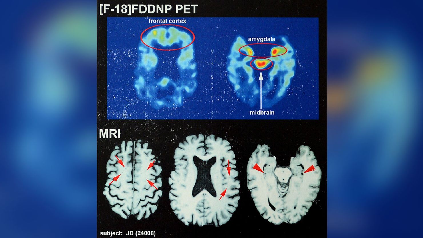 Recent brain scans of NFL hall of famer Joe DeLamielleure, who was diagnosed with CTE, the brain injury that is affecting so many former football players. (Jeff Siner/Charlotte Observer/MCT)