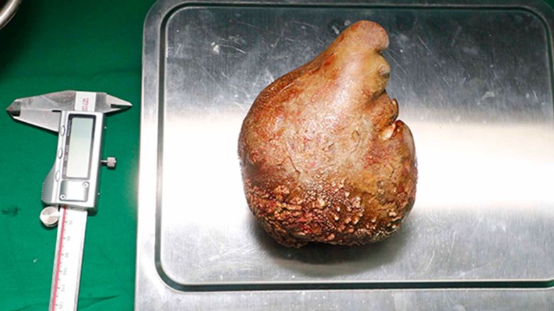 The removal of the world's largest and heaviest kidney stone through a major surgery took place on Thursday, June 1, at the Colombo Army Hospital.