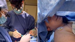 brain surgery split moos vpx