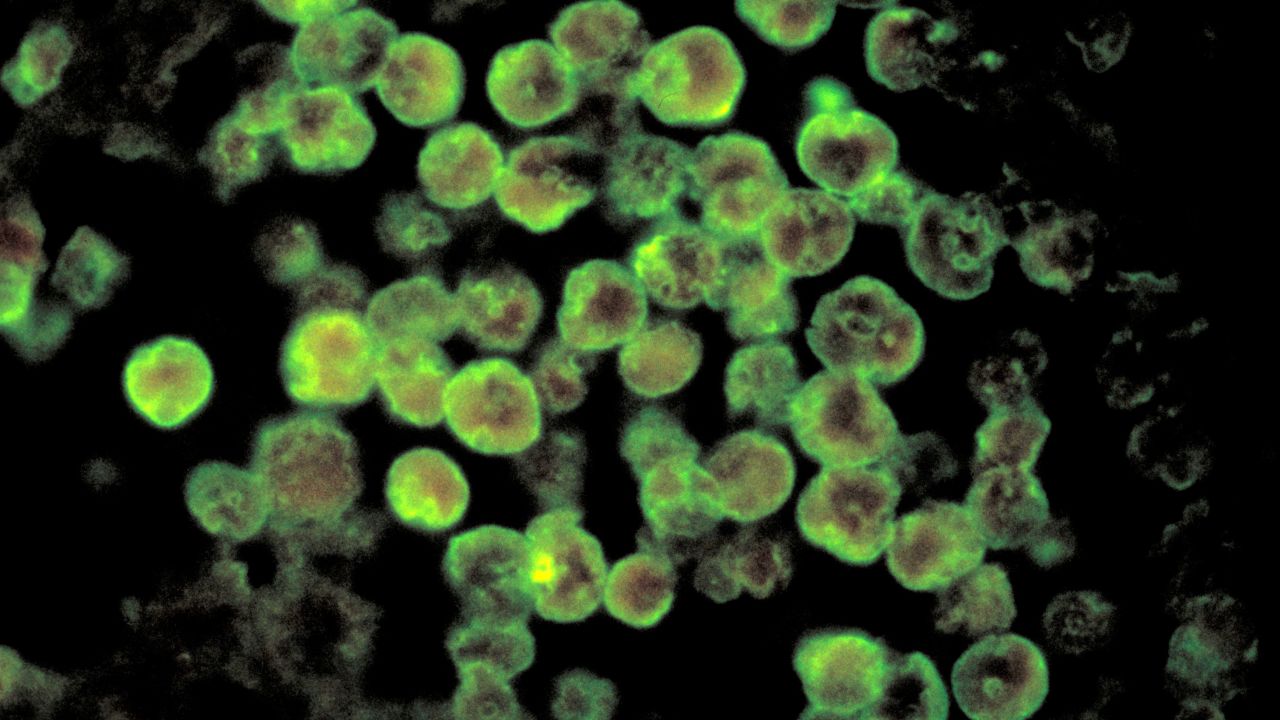 A handout photomicrograph provided by the Centers for Disease Control and Prevention (CDC) depicts the characteristics associated with a case of primary amebic meningoencephalitis, a rare brain infection due to Naegleria fowleri parasites, a brain-eating amoeba.  
