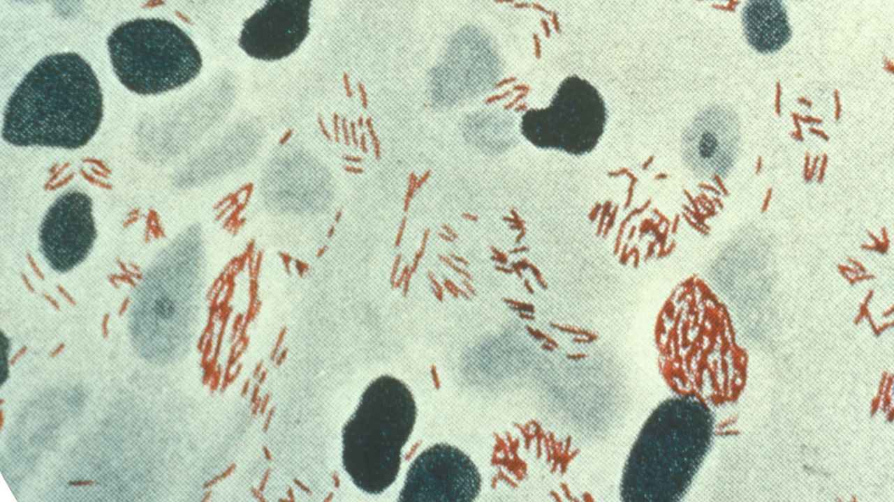 A photomicrograph of a specimen derived from a patient's lepromatous skin lesion, and reveals the presence of numerous Mycobacterium leprae bacteria, the cause of leprosy in humans.