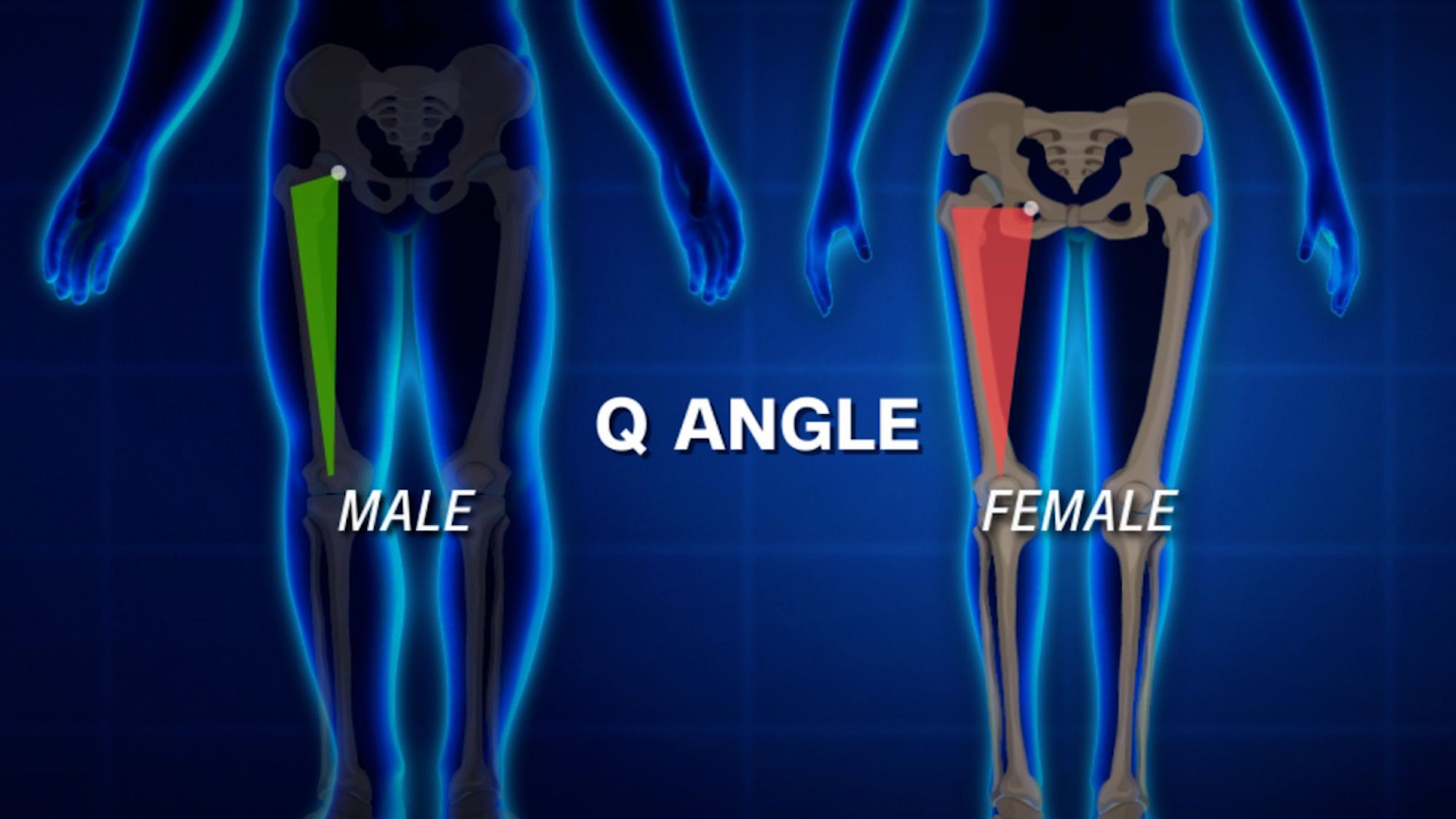 The Q angle is the ratio of hip width to femur length; women have larger Q angles, which can put more stress on the ACL.