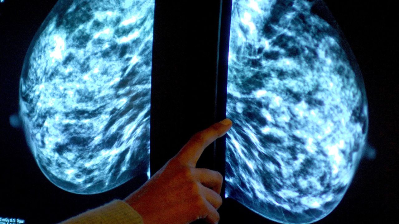 File photo dated 15/06/06 of a mammogram showing a woman's breast in order check for breast cancer at Derby City Hospital.