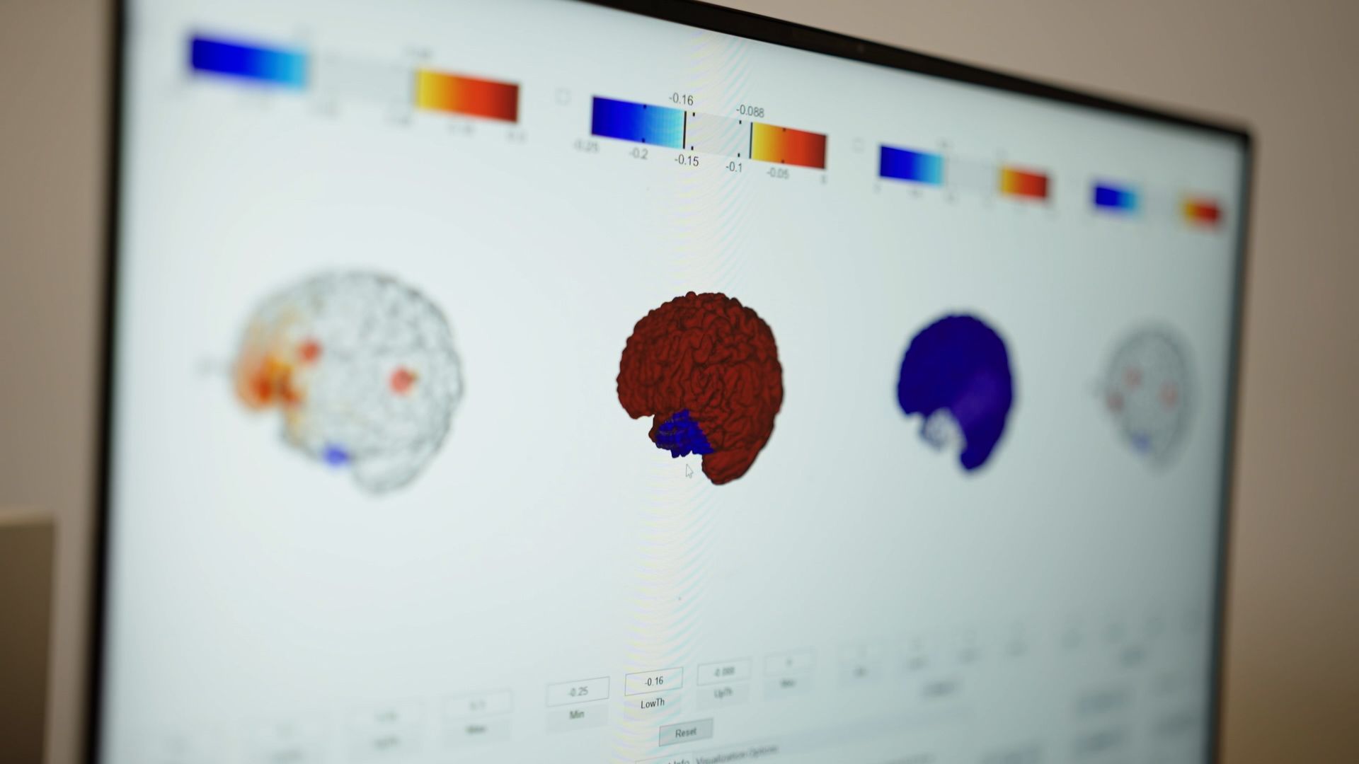 Frontiers  Digital Twins for Multiple Sclerosis