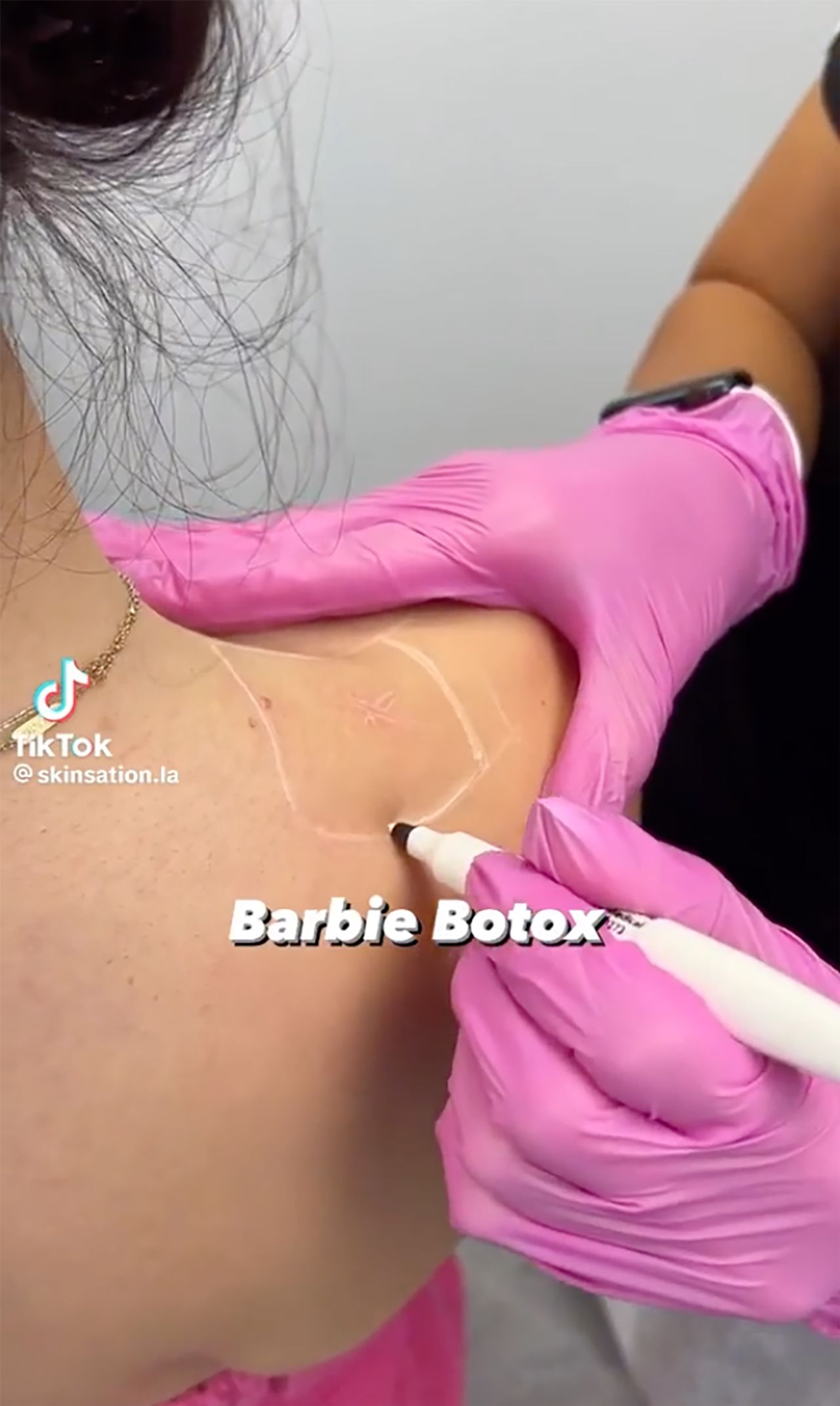 Barbie Botox