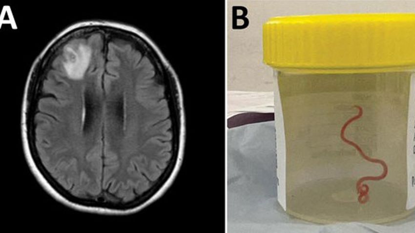 Detection of Ophidascaris robertsi nematode infection in a 64-year-old woman from southeastern New South Wales, Australia. A) Magnetic resonance image of patient's brain by fluid-attenuated inversion recovery demonstrating an enhancing right frontal lobe lesion, 13 × 10 mm. B) Live third-stage larval form of Ophidascaris robertsi (80 mm long, 1 mm diameter) removed from the patient's right frontal lobe.