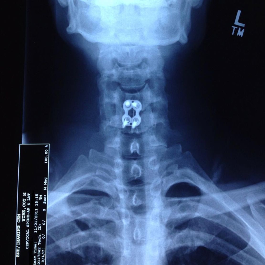 Coy Wire has a titanium plate and four screws in his neck due to a football injury sustained in his 6th year in the NFL.