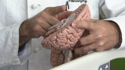 disconnect brain surgery 6-year-old rasmussen's encephalitis contd orig_mc_gr_00000000.png
