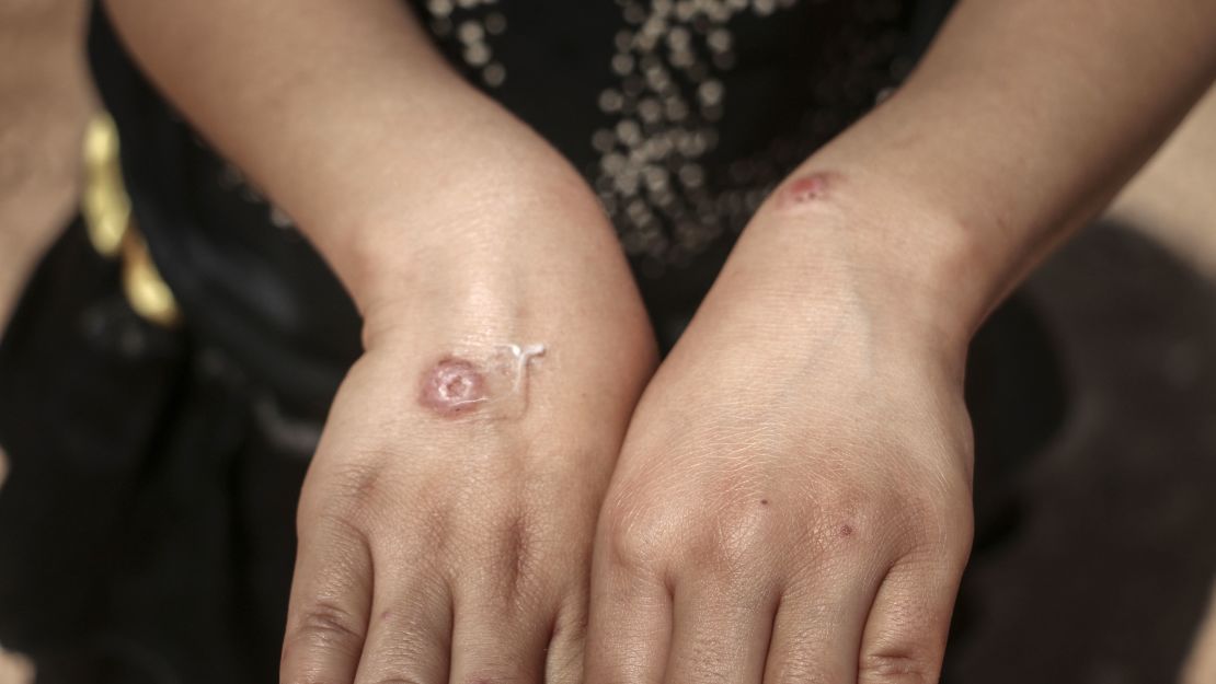 IDLIB, SYRIA - JULY 02: A Syrian kid suffering from leishmaniasis, a parasitic disease spread by the bite of phlebotomine sandflies, shows her hands in a refugee camp in Idlib, Syria on July 02, 2020. In the refugee camps in Idlib, danger of leishmaniasis disease arose due to inadequate living conditions and insufficient health services. In the camps where sheltered civilians escaping from the attacks of Assad regime and its supporters, infrastructure problems, especially exposed septic pits and damaged sewers, cause the spread of the disease. (Photo by Muhammed Abdullah/Anadolu Agency via Getty Images)