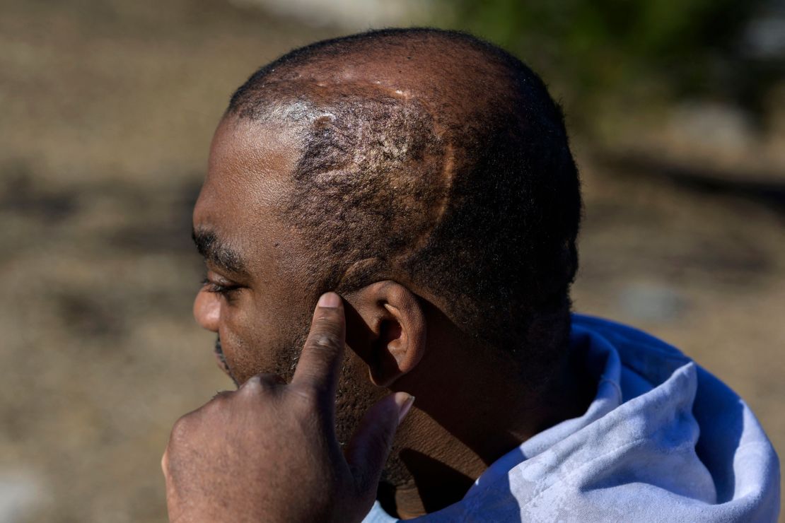 Community activist and gun violence survivor Oronde McClain, who was shot in the back of the head at 10 years old, points at his scar in Philadelphia, Pennsylvania, on March 16, 2023. 