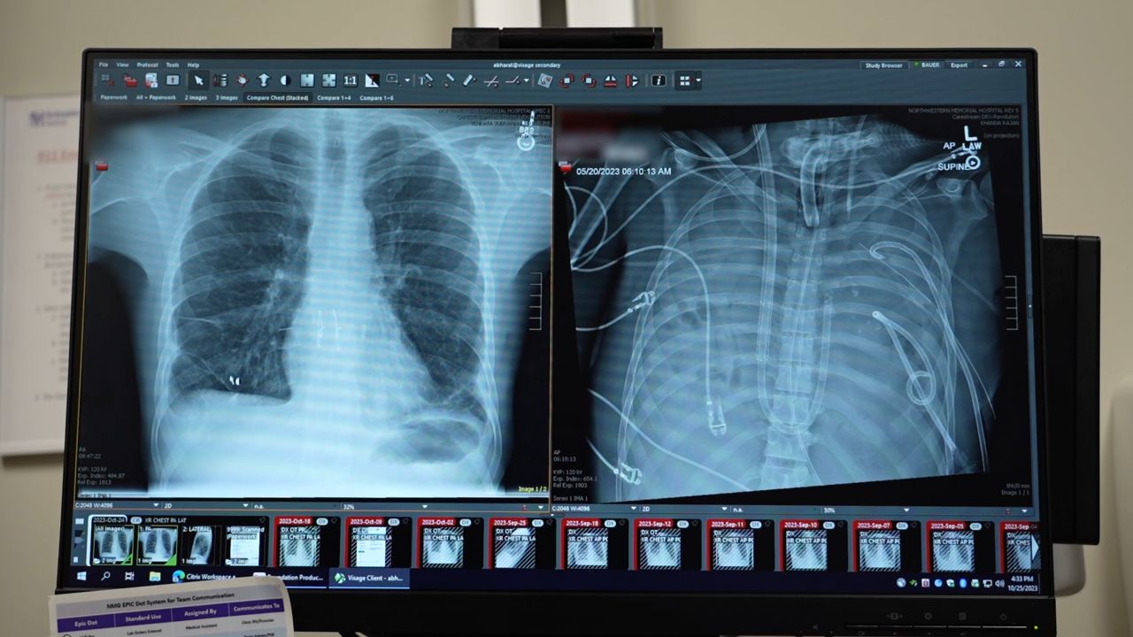 02 Northwestern Double Lung Transplant