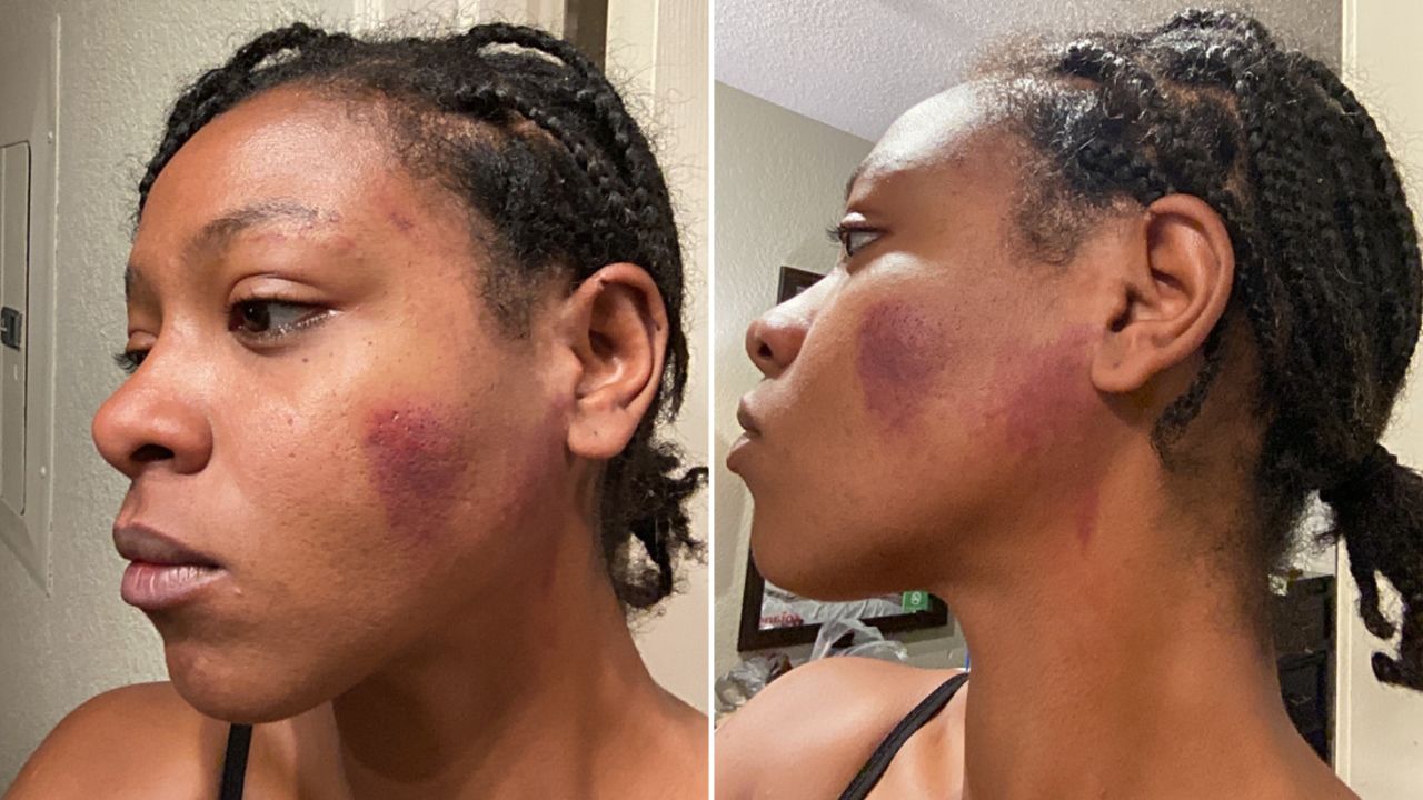 mages of Christina Pierre taken one day after an encounter with a police officer and supplied by ierre's attorney, Lauren Newton, show bruises on Pierre's face.