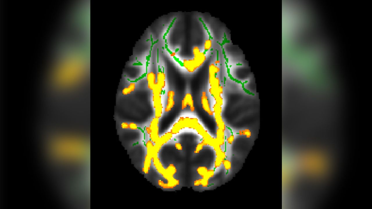 This figure shows increased neuroinflammation (yellow colors) with higher hidden fat (visceral fat) in our larger cohort of 54 persons with an average age of 50 years in the brain's white matter. The green colors are the normal white matter. There is increased neuroinflammation with a higher amount of visceral fat.