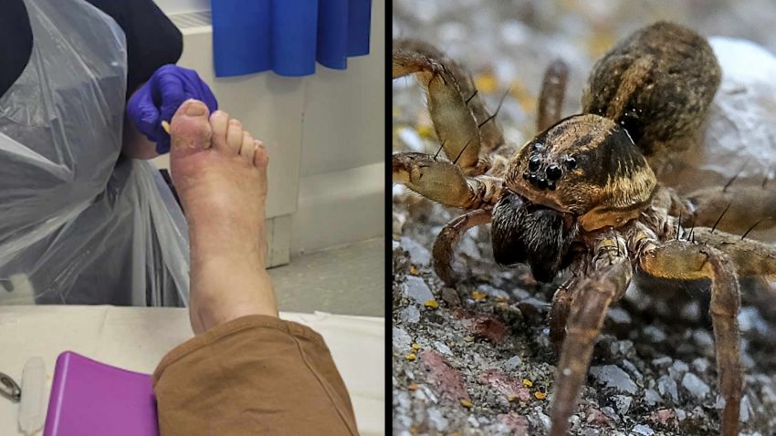 ‘Don’t worry, I’ve got them all out’: Man diagnosed with spider eggs in ...