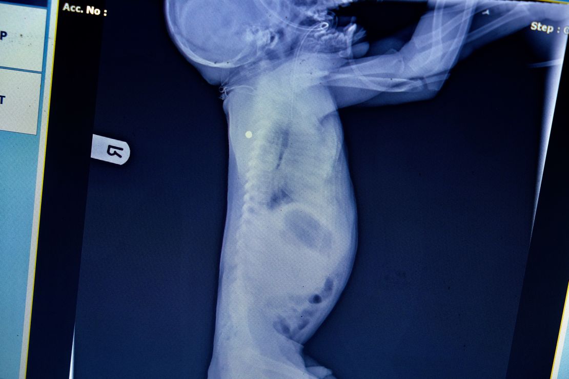 An x-ray shows where a pellet is still lodged in Siama's shoulder