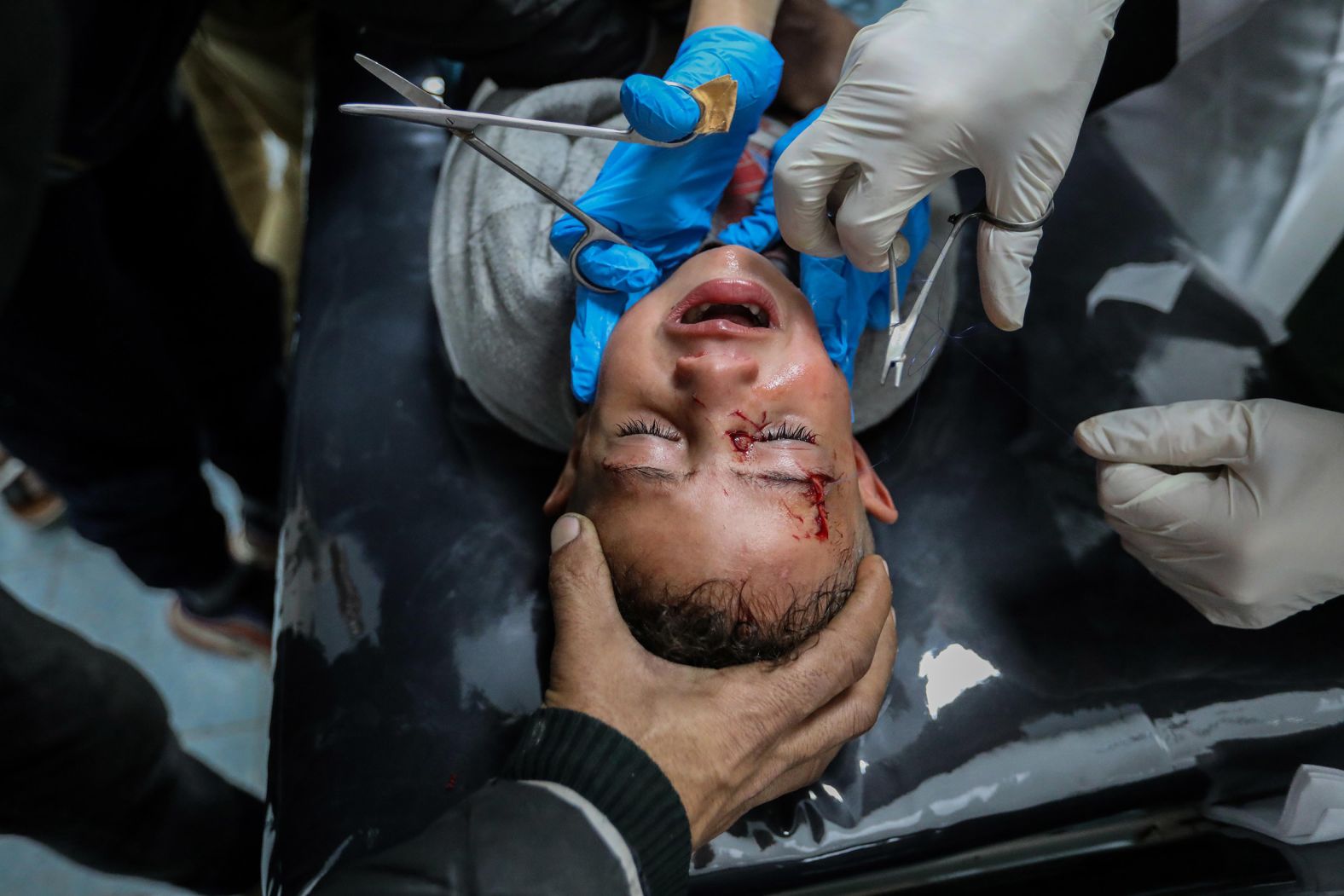 An injured Palestinian child receives treatment at a hospital in Rafah, Gaza, after Israeli airstrikes on February 7.