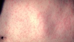 An example of a skin rash on a patient’s abdomen 3-days after the onset of a measles infection.
