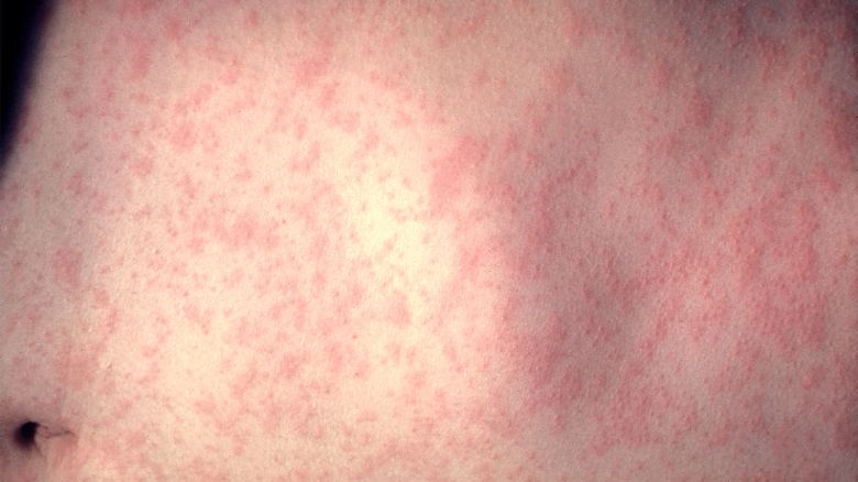 An example of a skin rash on a patient’s abdomen 3-days after the onset of a measles infection.