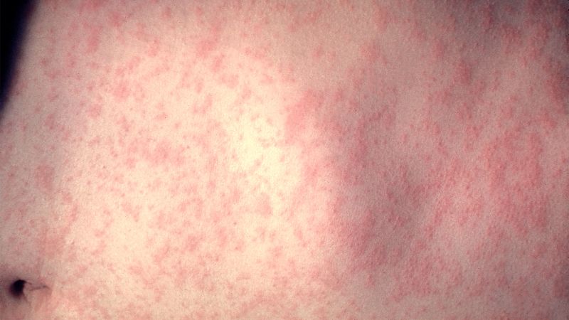Global measles cases nearly doubled in one year, researchers say - CNN