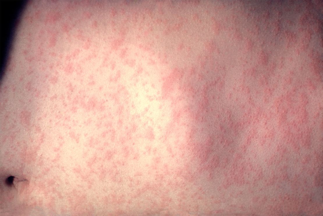 An example of a skin rash on a patient’s abdomen three days after the onset of a measles infection.