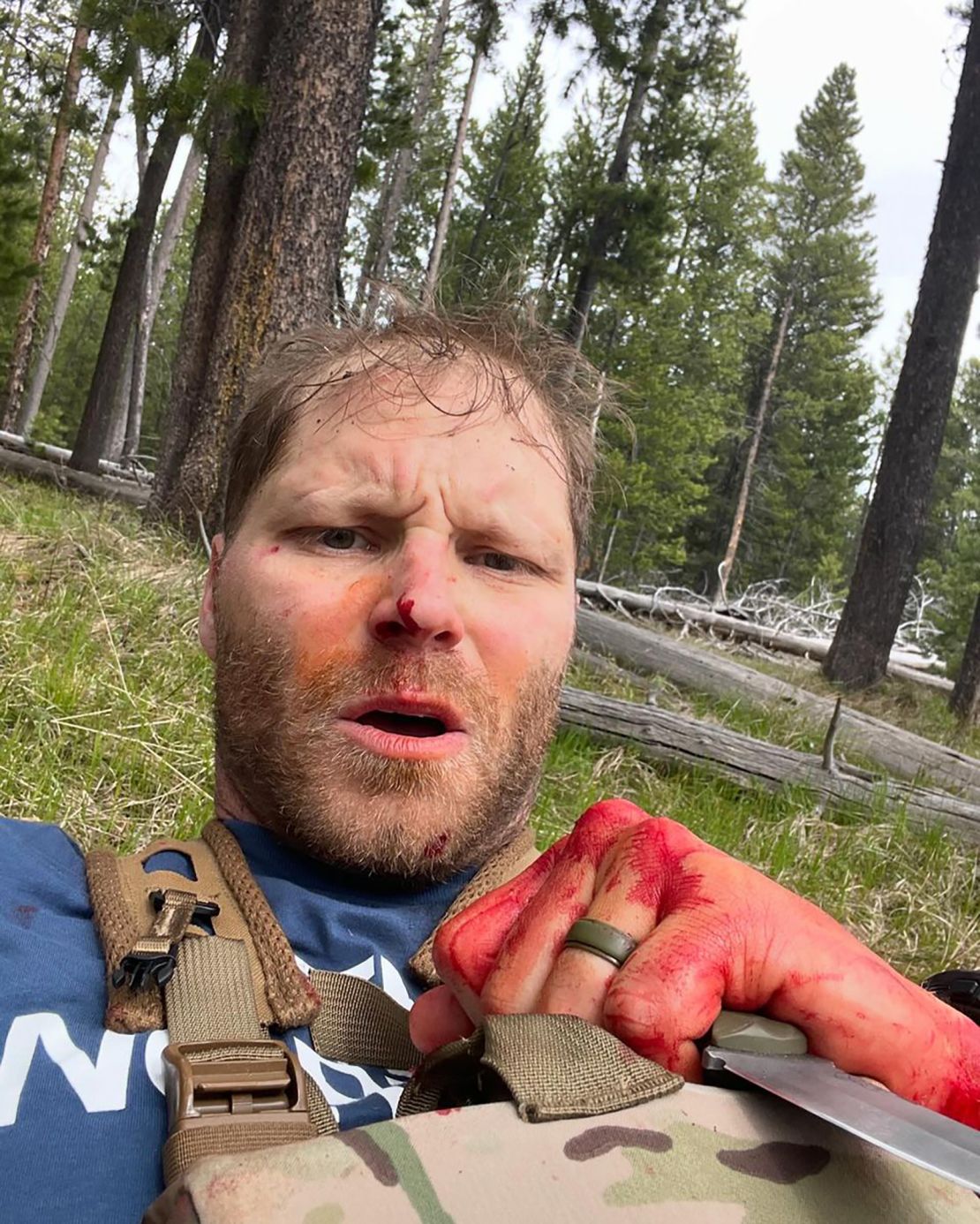 Shayne Burke survived a grizzly bear attack in May in Grand Teton National Park in Wyoming.