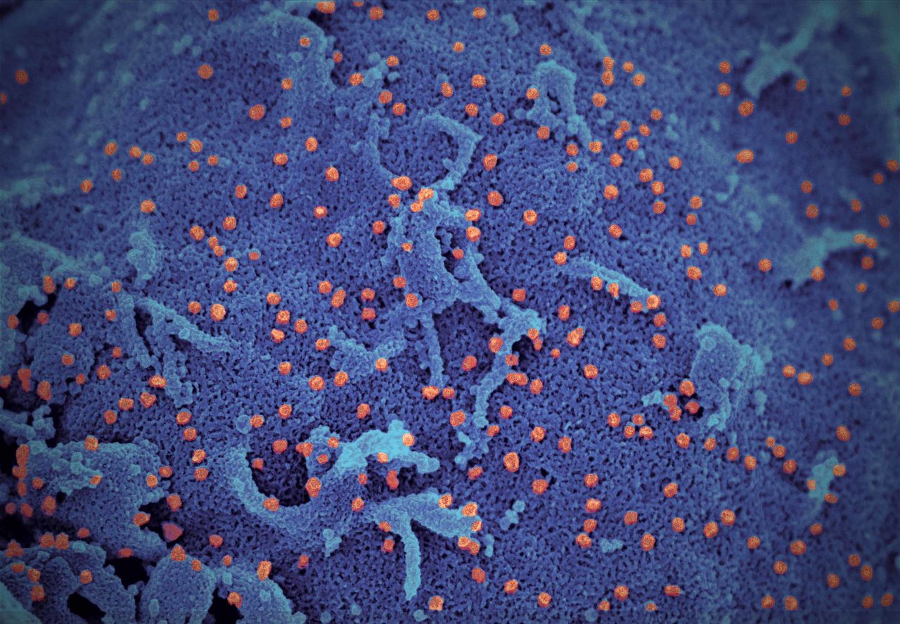 A pseudo-color scanning electron micrograph of SARS-CoV-2, grown in culture from a patient isolate. After 24 hours in culture there are large numbers of orange viral particles on the surface of the cell (blue).