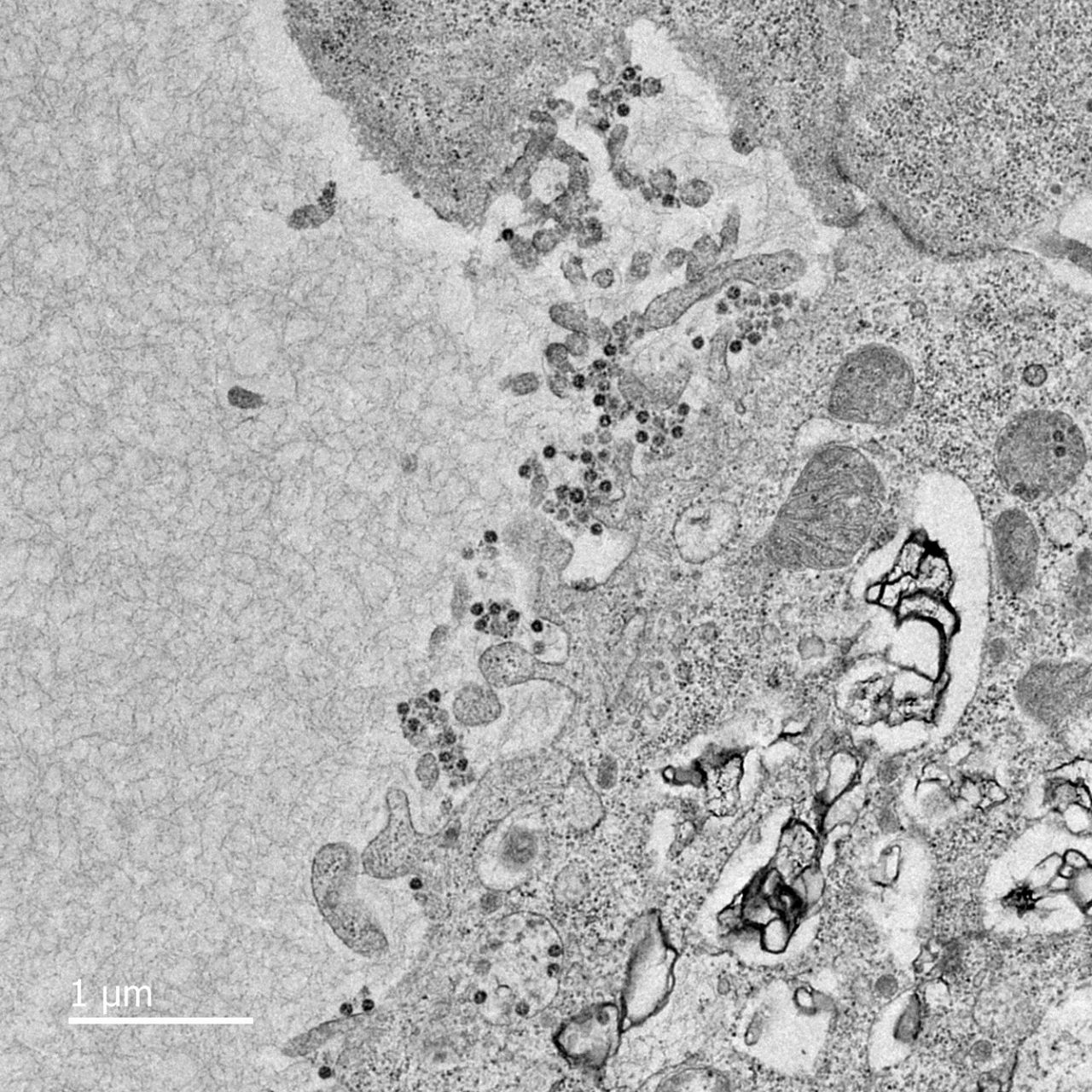 A photo of cells infected with the novel coronavirus, from a patient sample.