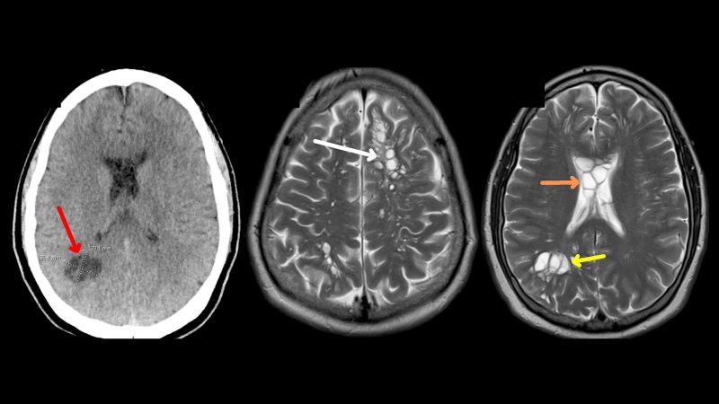 Gydytojai tiksliai nustato vyro migrenos šaltinį: jo smegenyse yra kaspinuočio lervos, greičiausiai dėl nepakankamai iškeptos šoninės.