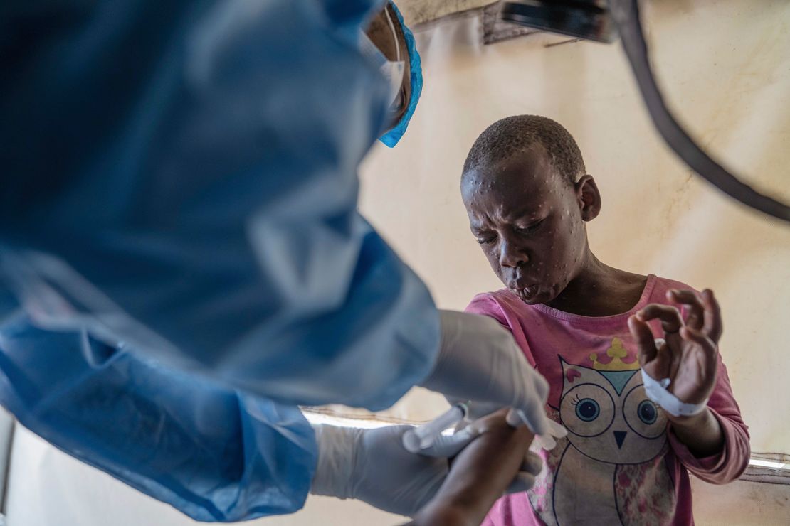 A health worker attends to an mpox patient in Munigi, eastern Congo, on August 19, 2024.