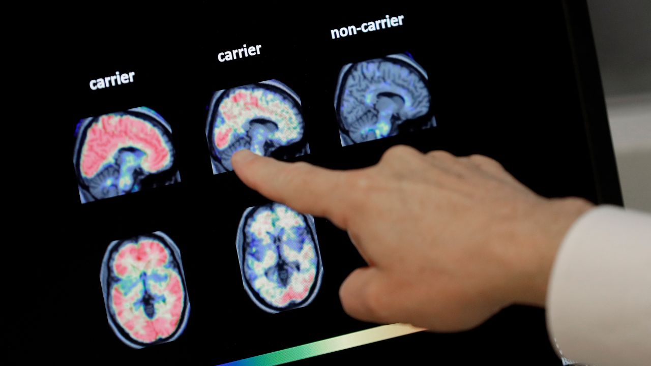 The new test may help reduce reliance on positron emission tomography or PET scans, a type of brain imaging that can be expensive.