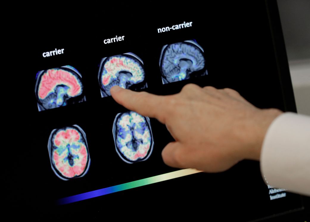 The new test may help reduce reliance on positron emission tomography or PET scans, a type of brain imaging that can be expensive.
