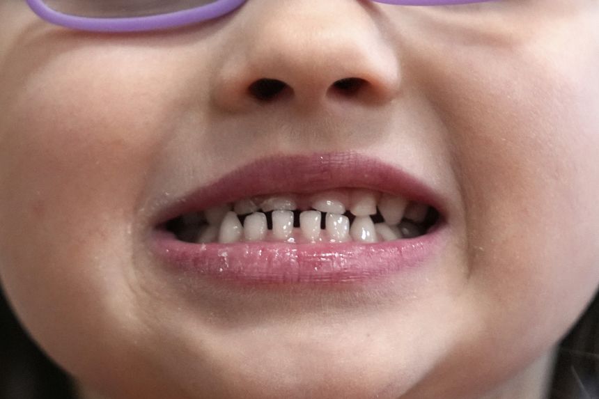 The FDA says fluoride supplements “should not be used in children under age 3 or by older children who are not at high risk of tooth decay.”