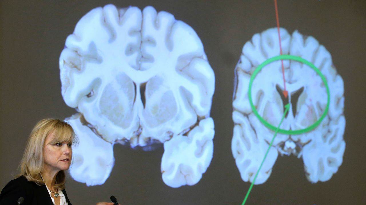 FILE - Ann McKee, director Boston University's center for research into the degenerative brain disease chronic traumatic encephalopathy, or CTE, addresses an audience on the school's campus Nov. 9, 2017 about the study of NFL football player Aaron Hernandez's brain, projected on a screen, behind right, in Boston. (AP Photo/Steven Senne, File)