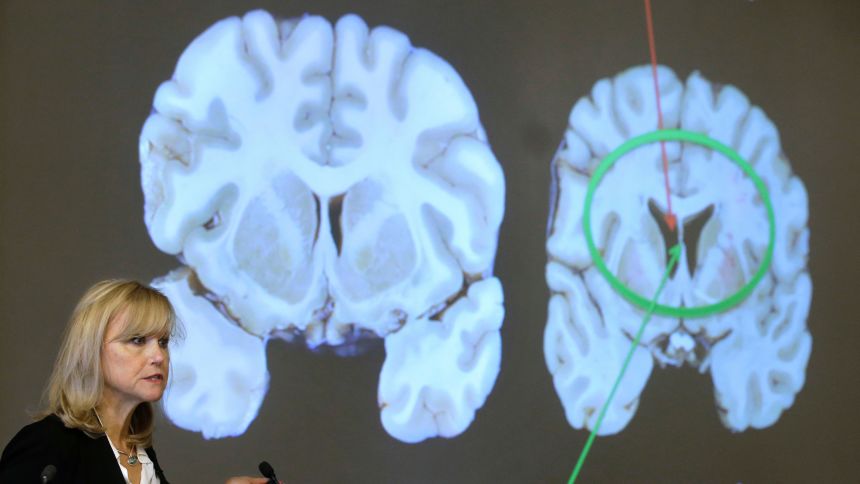 Research from Dr. Ann McKee of Boston University and other scientists examined the brains of people with and without CTE.