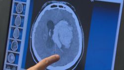 El nuevo medicamento contra el Alzheimer fue aprobado a principios de junio.