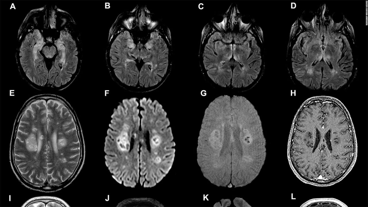 CNNE 1017481 - ¿afectaria el covid-19 al cerebro? estudio indica que si