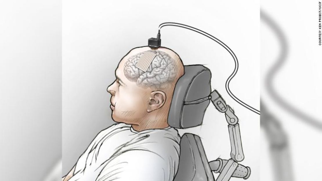 Ilustración que muestra la colocación del electrodo eCOG en la corteza motora del habla del participante y las etapas de la cabeza utilizadas para conectar el electrodo a la computadora.