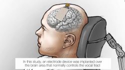 CNNE 1032233 - pudo volver a hablar gracias a implante en su cerebro