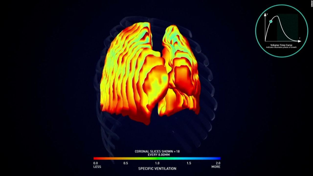 CNNE 1073657 - estudian el sindrome post-covid con escaneres 4d