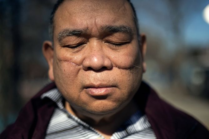 12 de marzo — Noel Quintana, un filipino estadounidense de 61 años, posa para un retrato cerca de su casa en Brooklyn, Nueva York. Quintana, que estaba en el metro cuando fue acuchillado en la cara con un bisturí, es uno de los miembros de la comunidad asiática que se han enfrentado a una serie de ataques racistas en los últimos meses en la ciudad de Nueva York y en todo el país. Los delitos de odio contra los asiáticos aumentaron a principios de 2021, según el Centro para el Estudio del Odio y el Extremismo de la Universidad Estatal de California en San Bernardino.