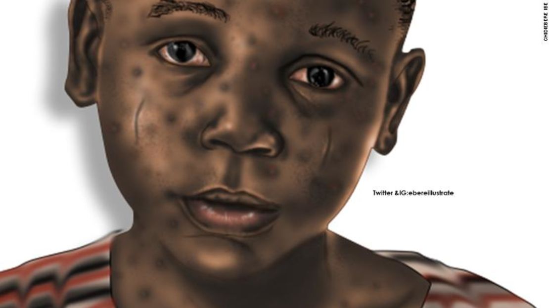 La gran mayoría de las imágenes de los libros de texto de anatomía son de personas blancas. Ibe está trabajando en un libro de texto sobre defectos de nacimiento en los niños, que, según dice, estará ilustrado con imágenes de piel negra.