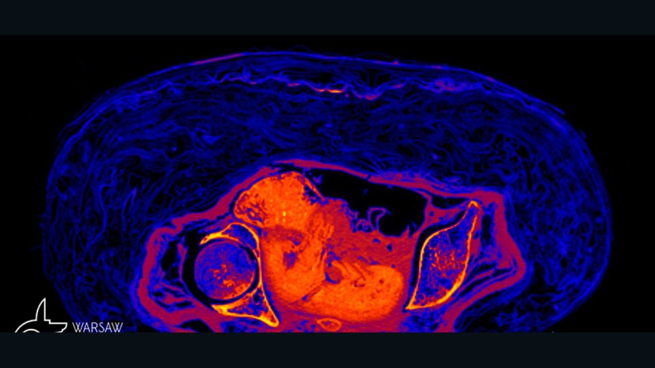 CNNE 1143155 - las primeras imagenes de un feto egipcio momificado