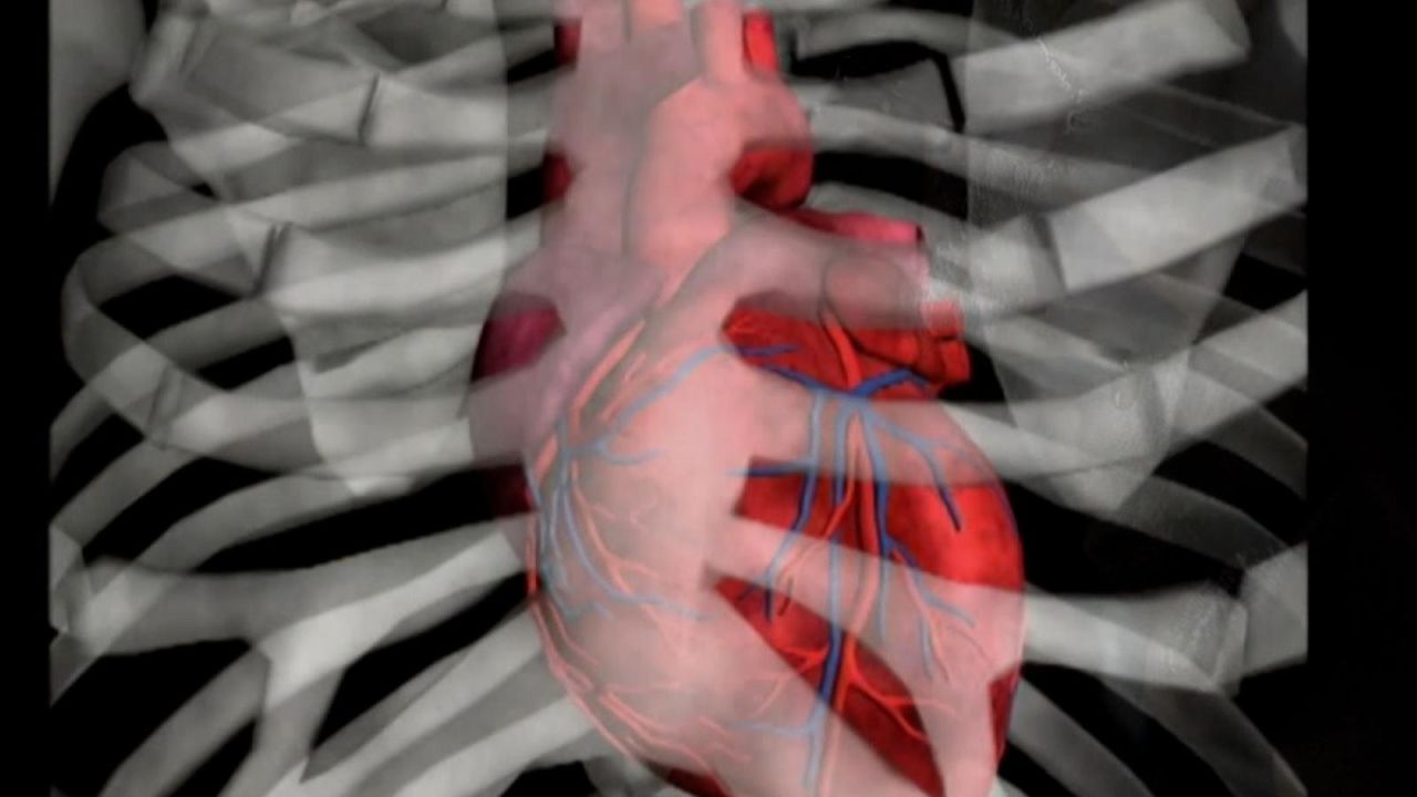 CNNE 1153787 - el amor puede romper tu corazon y tambien un curioso sindrome