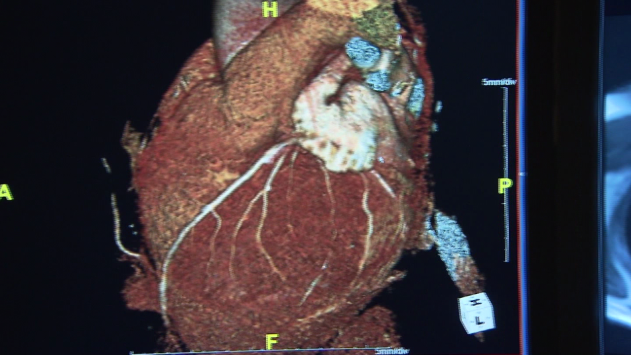 CNNE 1153927 - 5 consejos para cuidar la salud de tu corazon mas alla de san valentin