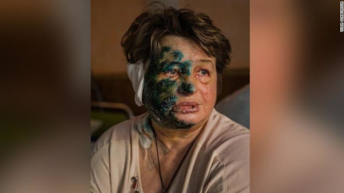 Halyna Moroskhovskaya, de 59 años, fotografiada con un antiséptico en el rostro en un hospital de Mariúpol, tras sufrir un ataque.