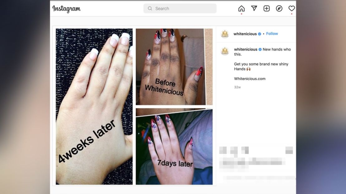 Una publicación de Instagram anunciando un proceso de blanqueamiento de la piel. CNN ocultó parte de esta imagen para proteger la privacidad de las partes no relacionadas. Crédito: De Instagram