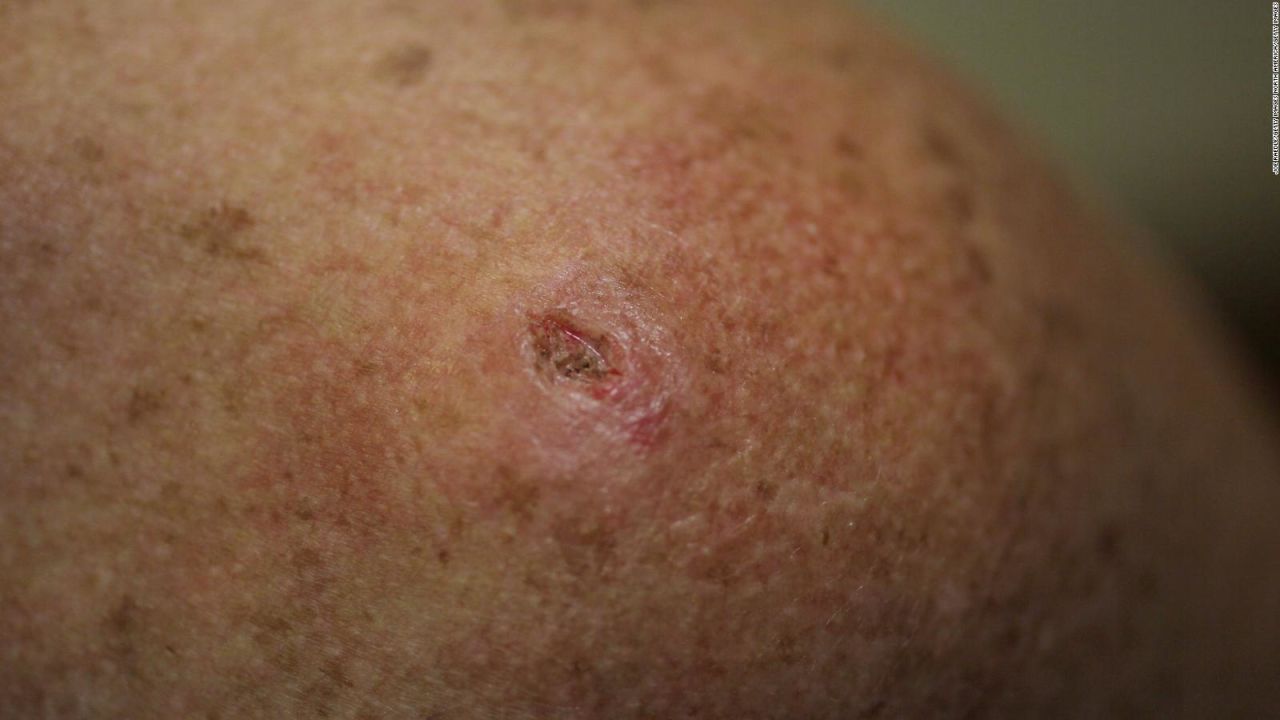 CNNE 1255263 - asi deberias de protegerte frente al cancer de piel