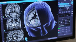 CNNE 1264228 - conoce el tratamiento experimental contra covid prolongado