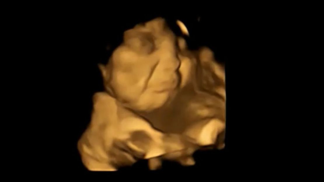 Una imagen de escáner 4D del mismo feto que muestra una reacción de cara de molestia tras ser expuesto al sabor del kale. Crédito: FETAP/Laboratorio de Investigación Fetal y Neonatal/Universidad de Durham