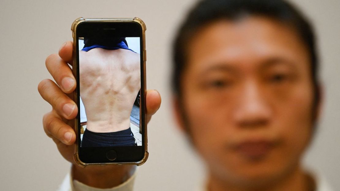 El manifestante de Hong Kong Bob Chan muestra una fotografía de sus heridas en una conferencia de prensa, en Londres, el 19 de octubre. Crédito: Toby Melville/Reuters